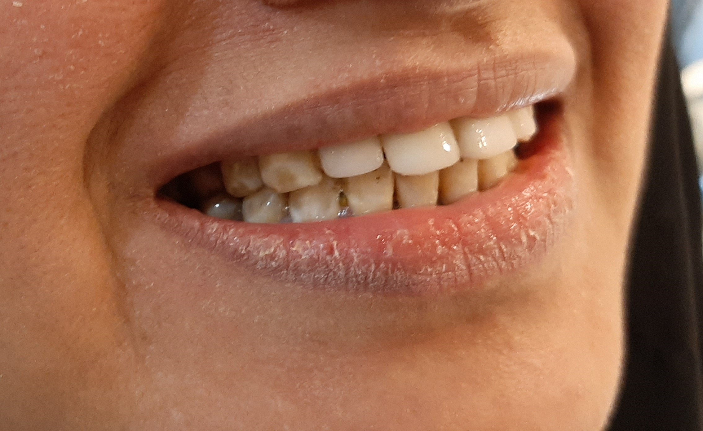 a case of veneer at dr eman tantawy clinic