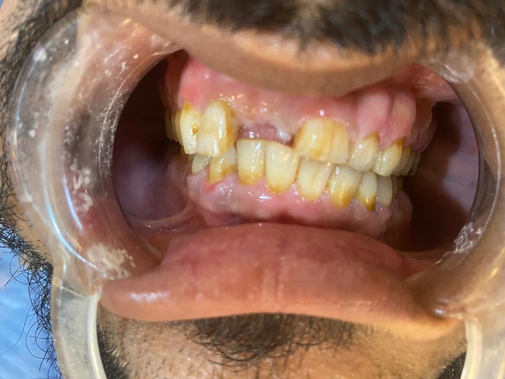 difficult case done at our dental clinic