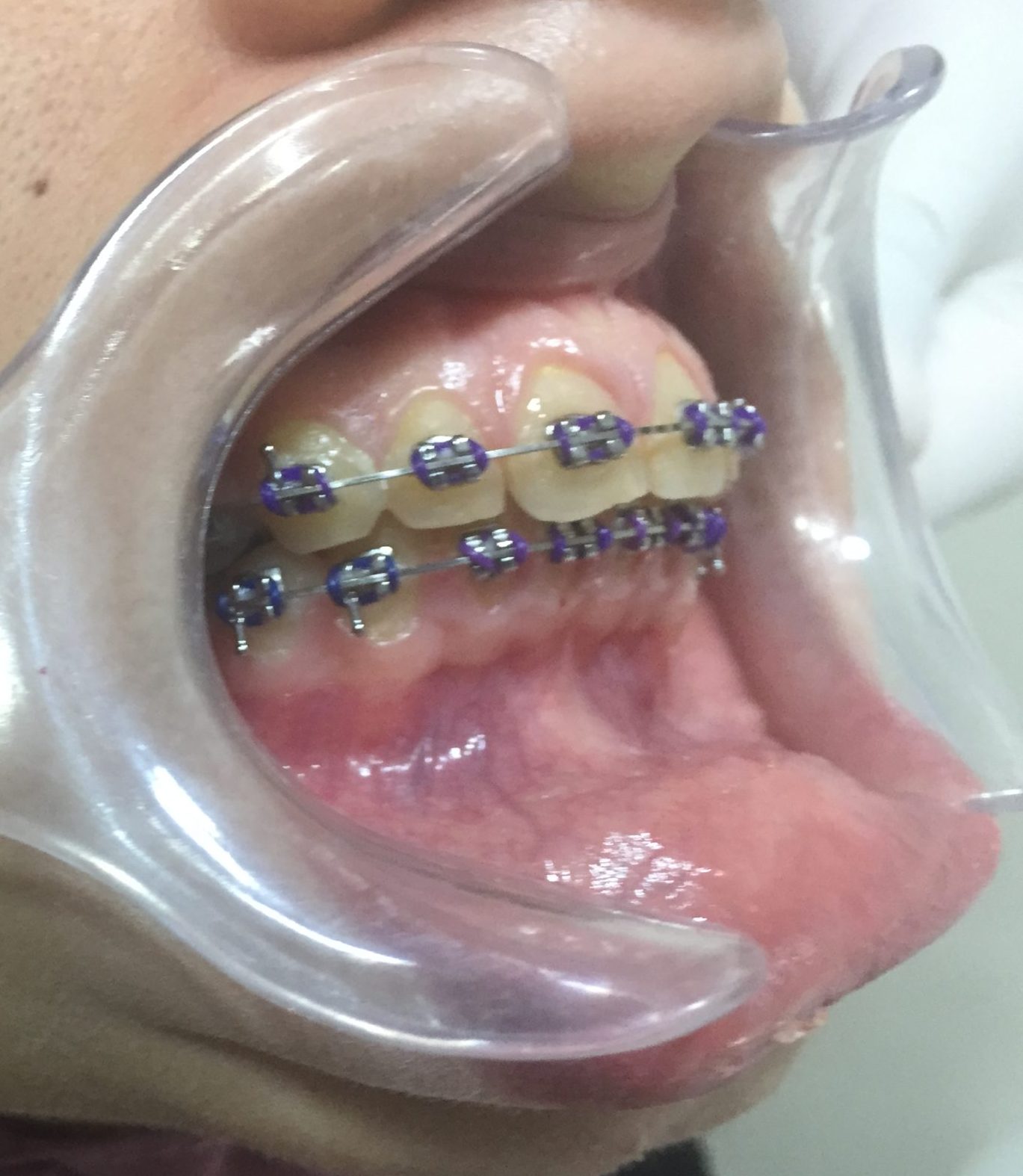 ortho for protruded teeth