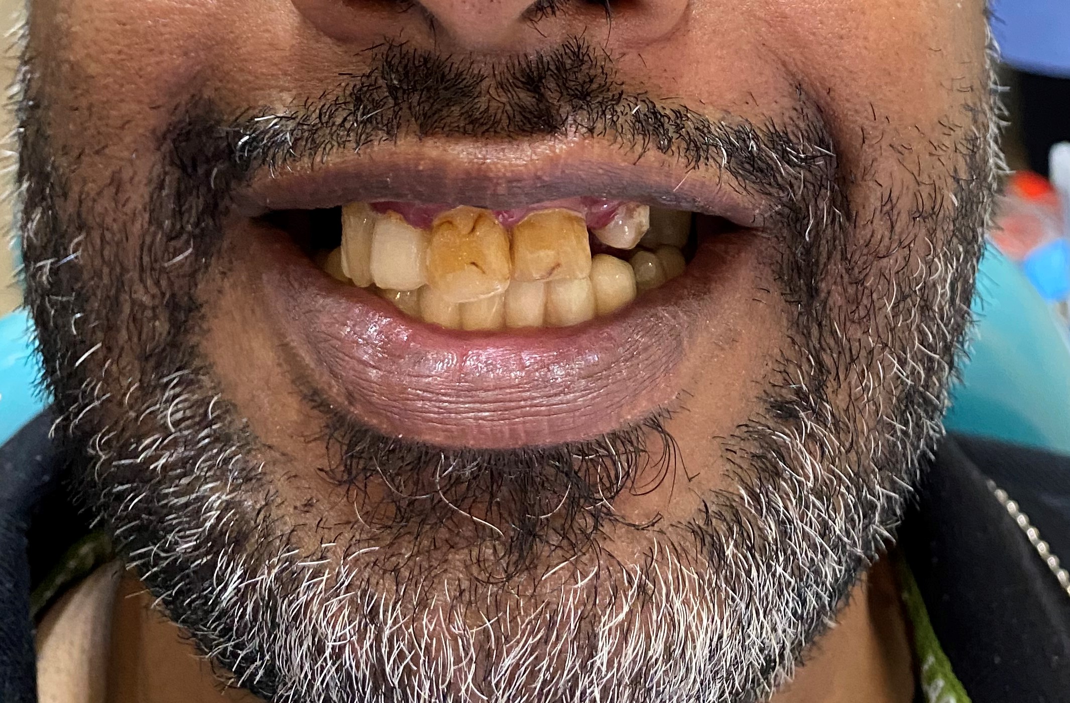 discolored teeth treated at a dental clinic
